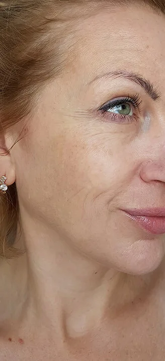 Лазерное омоложение лица — до процедуры